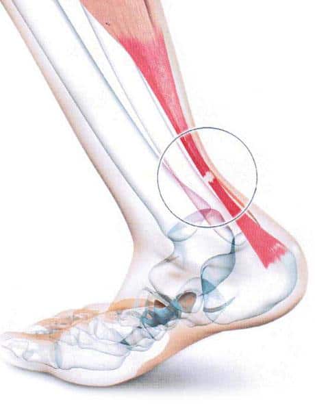 tendinite tendon achille
