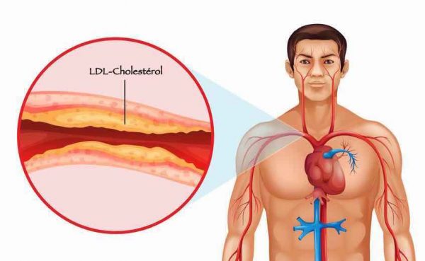 cholestérol ldl
