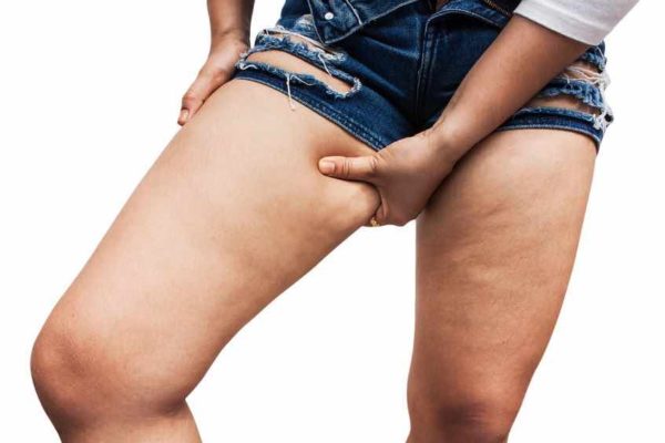 cellulite cuisse