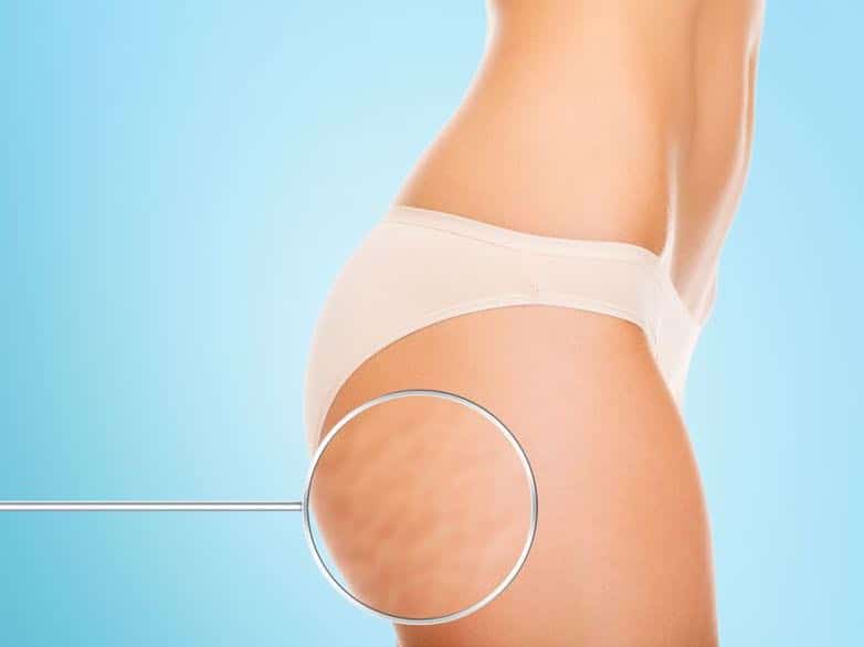 perdre cellulite fessier